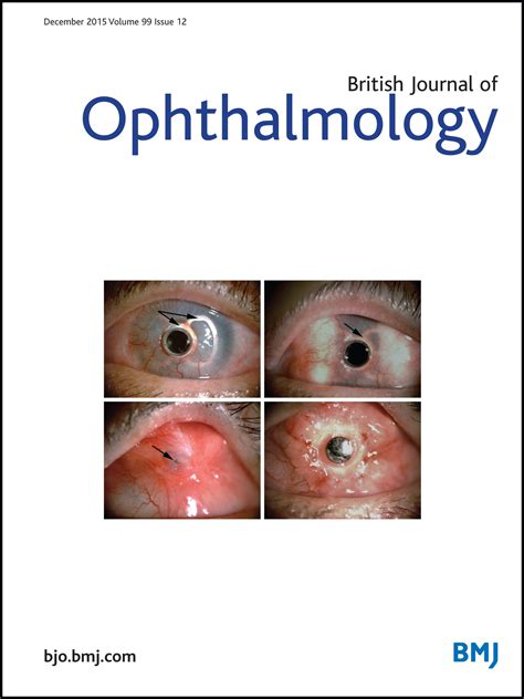 ruthenium lump|Ruthenium106 plaque brachytherapy for uveal leiomyoma: a new .
